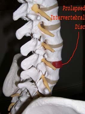 Model of Spine showing Prolapsed Disc