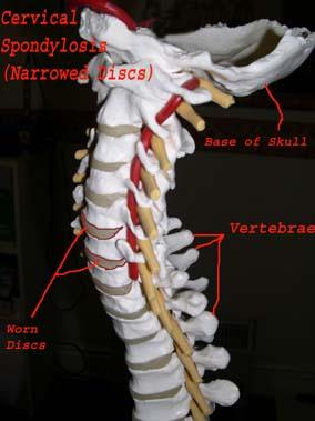 Degenerated Disc Side View