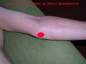 Location of Golfer's Elbow Pain