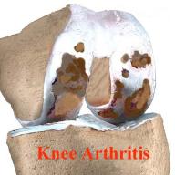 Arthritic Knee Joint