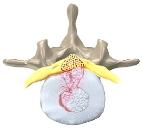 Herniated Disc