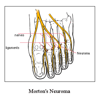 Ligaments and Nerves in Morton's Neuroma