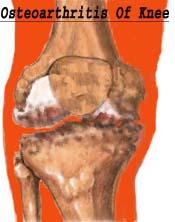 diagram of interier of arthritic knee joint