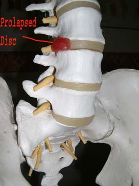 Model of Spnie showing Prolapsed Disc