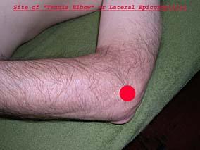 Site of Tennis ELbow Pain